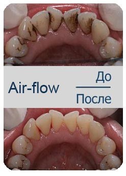 чистка зубов Air-Flow до и после