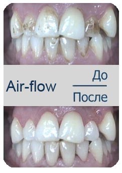 чистка зубов Air Flow до и после