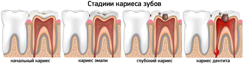 Стадии кариеса зубов