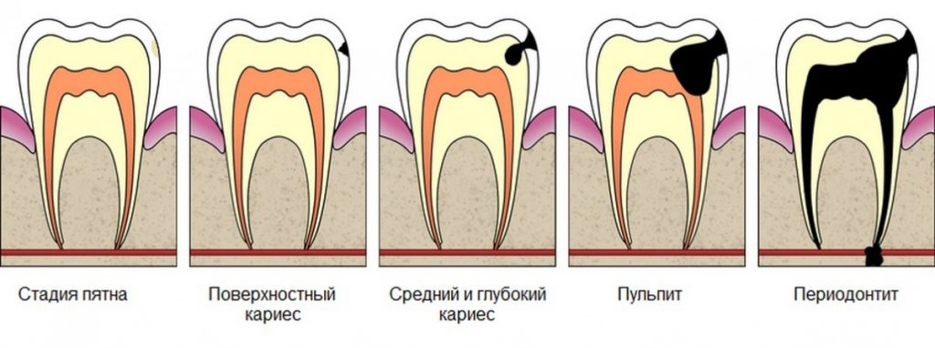 Лечение зубов виды