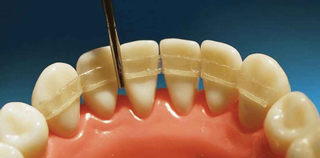 Стекловолоконное шинирование зубов
